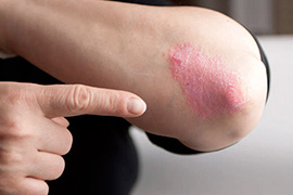 Dépistage du psoriasis